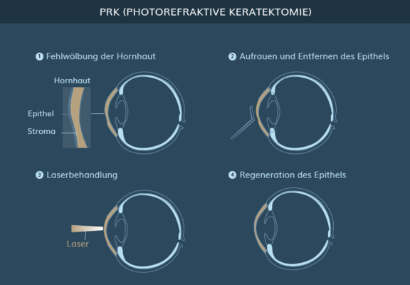 Graphik PRK Augen Lasern, info Ästhetik