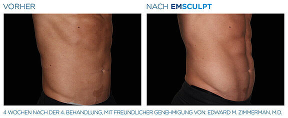 emsculpt-vorher-nachher-06-info-aesthetik.jpg 