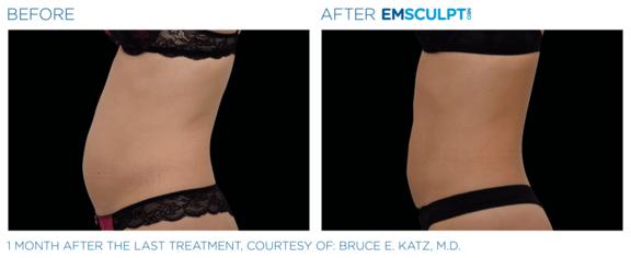 emsculpt-neo-vorher-nachher-02-info-aesthetik.png 