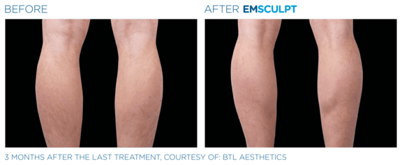 emsculpt-neo-vorher-nachher-10-info-aesthetik.png 