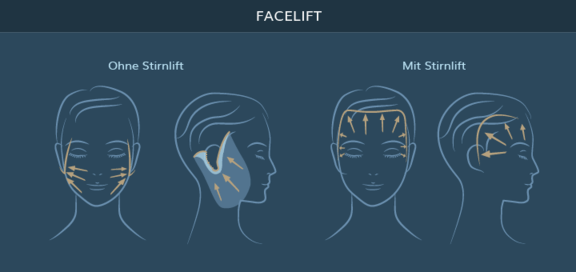 Graphik Facelift mit und ohne Stirnlift, info Ästhetik